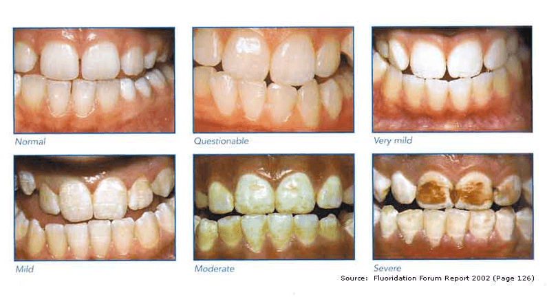 fluoride in water